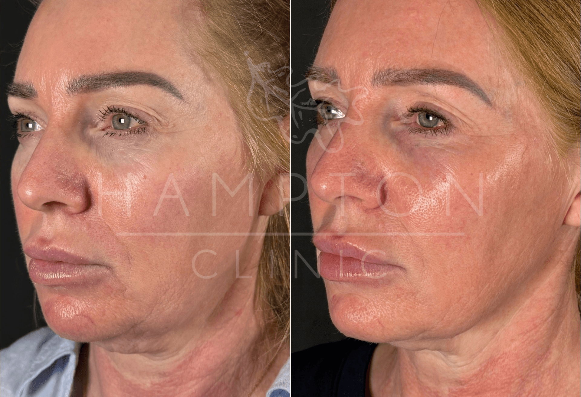NeoGen before-and-after comparison supplied by Hampton Clinic